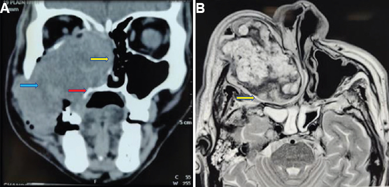 (A) Contrast computed tomography of paranasal sinus, coronal cuts showing an expanding heterogeneous mass with its epicentre in the maxillary sinus. Yellow arrow shows destruction of the nasal septum with extension to the opposite side. Red arrow shows the erosion of the palate. Blue arrow shows the erosion of the lateral wall of the maxillary sinus. (B) Axial section of T2-weighted magnetic resonance imaging also showed the well-encapsulated heterogeneous mass, yellow arrow shows the capsule.